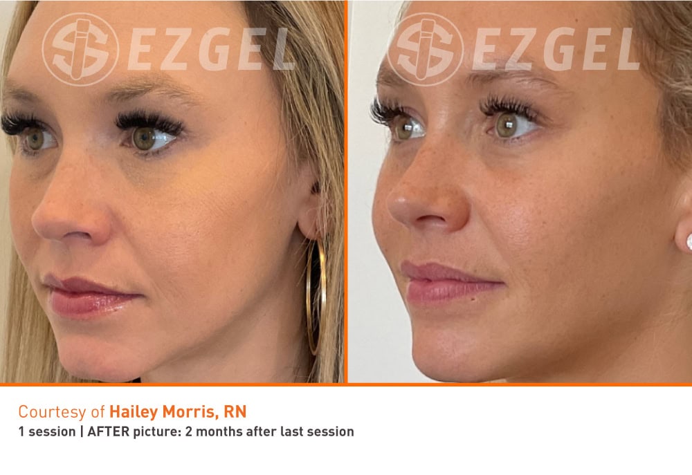 PRF, PRF EzGEl ,Solon, OH, facial rejuvenation